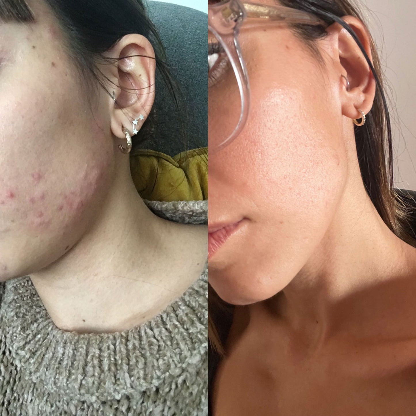 Rutina anti acne
