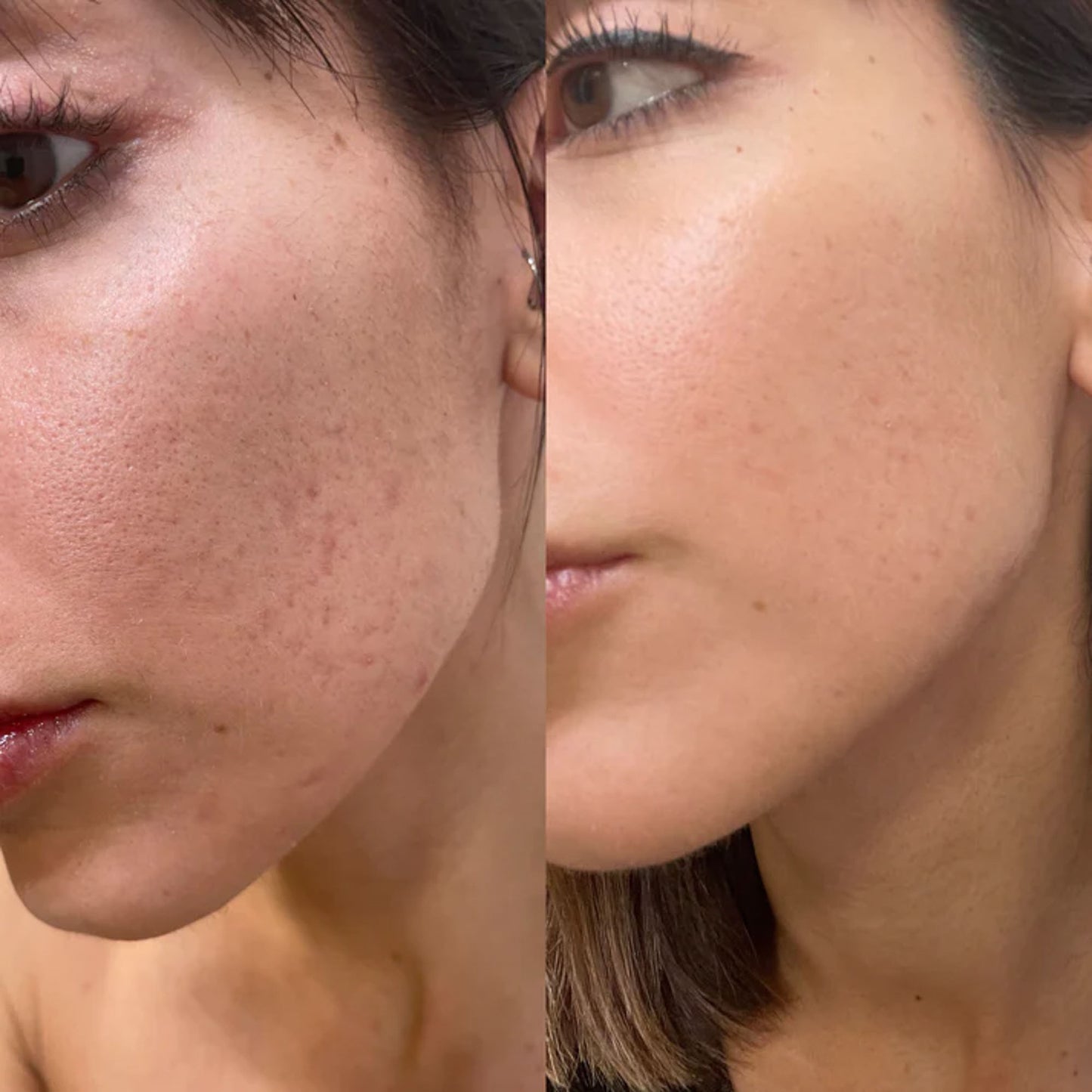 Rutina anti acne